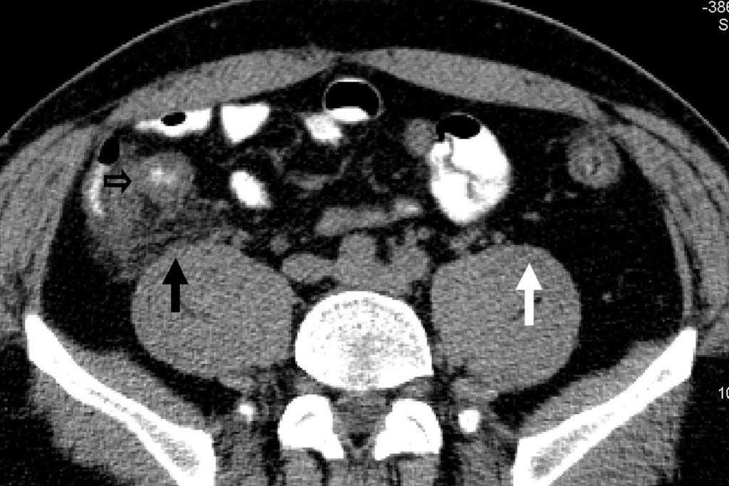 47-year-old man with abdominal pain and leukocytosis. Open arrow shows an enlarged appendix with periappendiceal stranding.