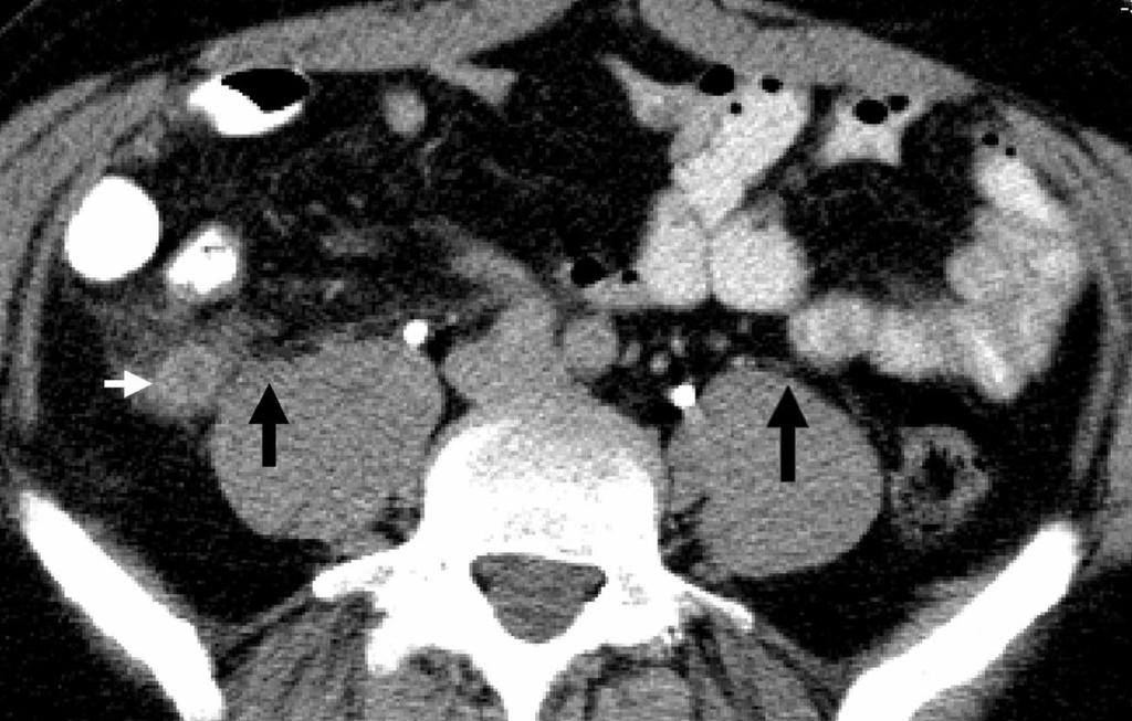 46-year-old patient with abdominal pain and proven appendicitis. Small white arrow shows a right pelvic appendix with an intensely enhancing wall and periappendiceal stranding.