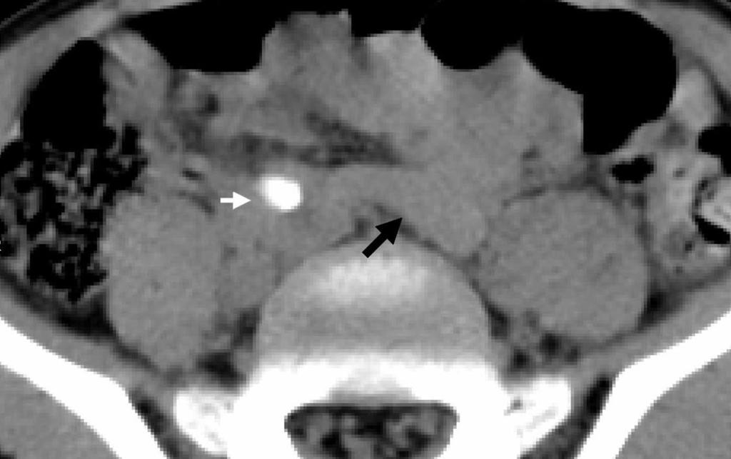 CT OF CUTE PPENDICITIS FIGURE 21. 26-year-old man with right flank pain and proven appendicitis. lack arrow indicates a calcified appendicolith. FIGURE 22.