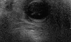 echogenic submucosal layer Absent blood flow in thickened