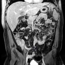 Proposed MR appendicitis protocol Current MR protocol Axial T2 Coronal T2 +/ Sagittal T2 Coronal bssfp Axial bssfp Axial post contrast Coronal post contrast Proposed MR