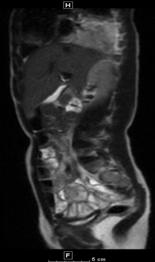MRI is valuable in the work up of appendicitis High sensitivity and specificity ALARA principal Alternate diagnoses Most common
