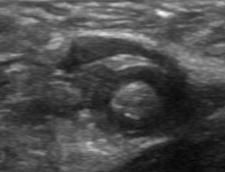 found the inflamed appendix by US 1990: Radiology