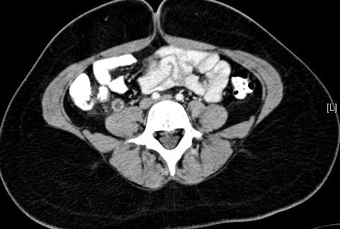 visualized in 10% of patients with appendicitis Obesity, abdominal wall rigidity, uncooperative children, atypical location, less experienced examiners CT