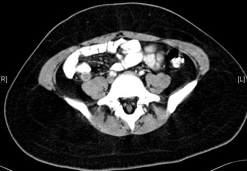 Helical CT technique for the diagnosis of appendicitis: prospective evaluation of a focused appendix CT examination 100 patients enteric contrast,