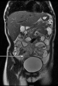 findings in acute appendicitis by MRI Blind ending