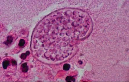 OIs: Fungal disease o Candidiasis of bronchi, trachea, or lungs o Candidiasis, esophageal o Coccidioidomycosis, disseminated or