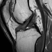 Normal ACL Figure 1: MRI images of the ACL of the knee knee.
