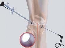 a. Surgical Procedure Section: 3 The surgeon makes two small incisions (about ¼ of an inch) around the joint area.