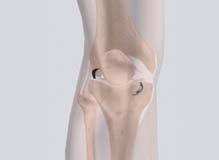 Along with the arthroscope, a sterile solution is pumped to the joint which expands the knee joint giving the surgeon a clear view and