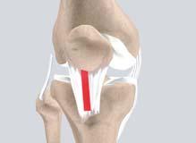 18) The remaining portions of the patellar tendon on either side of the graft are re-approximated (sutured) after its removal. The incision is closed.
