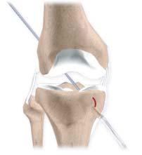 INTRODUCTION "Doc, I fell and twisted my knee. I heard a pop. It hurt briefly." This could be a ligament tear or rupture. Ligaments are tough, non-stretchable fibers that hold your bones together.