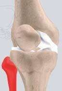 Fibula Section: 1/cont. NORMAL KNEE The fibula, although not a weight bearing bone, provides attachment sites for the Lateral collateral ligaments (LCL) and the biceps femoris tendon.