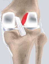 b. Fibrous Tissue Anterior Cruciate Ligament (ACL) Section: 1/cont. NORMAL KNEE The anterior cruciate ligament (ACL) is the major stabilizing ligament of the knee.