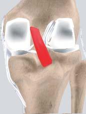 The ACL prevents the femur from sliding backwards on the tibia (or the tibia sliding forwards on the femur).