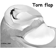 Flexion: Torn meniscus