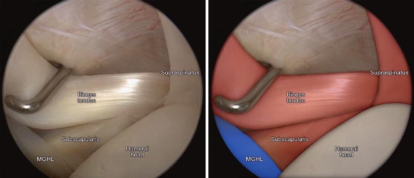 6 () Arthroscopic evlution of iceps tendon with prop () Colored view of the ntomic structures whether or not there is cpsulr seprtion.