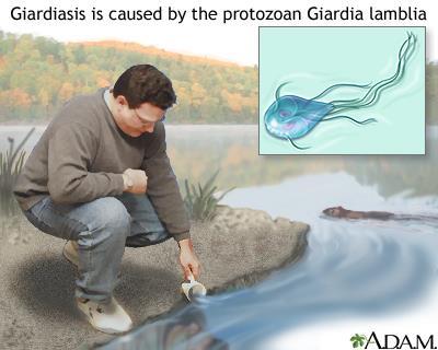 Protozoan Infections Giardia is a protozoan infection of the small intestines and causes severe diarrhea.