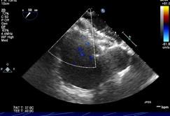 REPORTED LATE COMPLICATIONS Atrial-aortic wall erosions