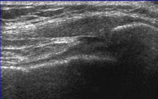 Ultrasound of the Knee Jon A. Jacobson, M.D.