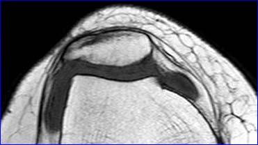 partial knee flexion Medial