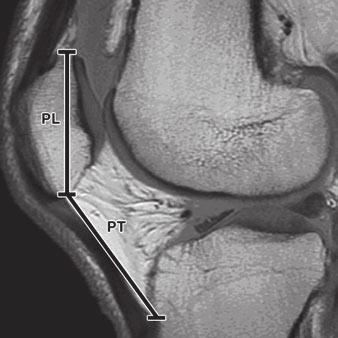 Ali et al. that abnormal contact between the patella and the femur due to superior displacement of the patella can produce malalignment of the patellofemoral joint [15].