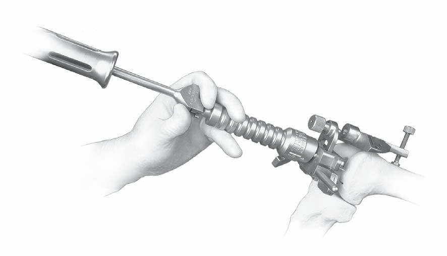 POSTERIOR REFERENCE Use the Slaphammer Extractor to remove the IM Alignment Guide and the Distal Placement Guide (Fig. 9).