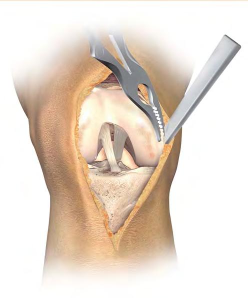 Incision and Exposure Figure 5 Excise hypertrophic synovium if present and a portion of the infrapatella fat pad to allow access to the medial, lateral and intercondylar spaces.