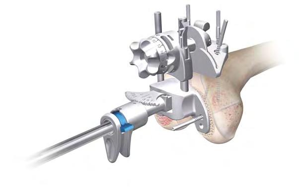 Distal Femoral Resection Release attachment 1. Slide femoral resection guide upwards 2.