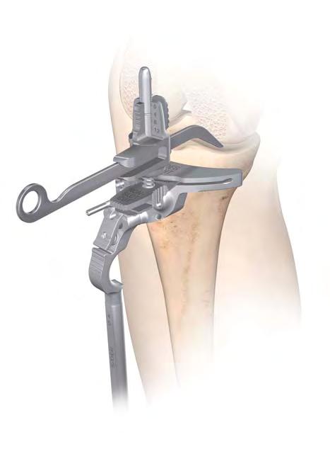 Lower Leg Alignment Non-slotted stylus foot Fine tune adjustment Figure 29 Height When measuring from the less damaged side of the tibial plateau set