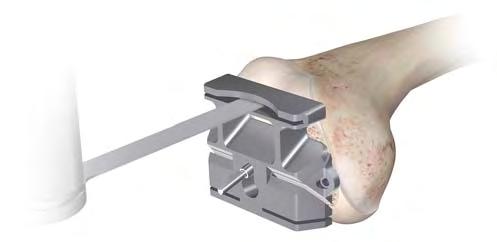 Secure and stabilise the Sigma or RPF After securely fixing the femoral chamfer chamfer blocks