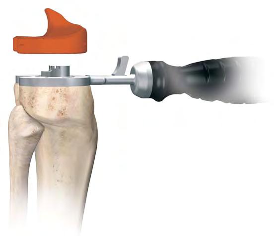 Trial Components (For Fixed Bearing, see Appendix A) Cautery marks Figure 49 Figure 50 Figure 51 Select the tibial insert trial that matches the chosen femoral size and style, curved or stabilised,