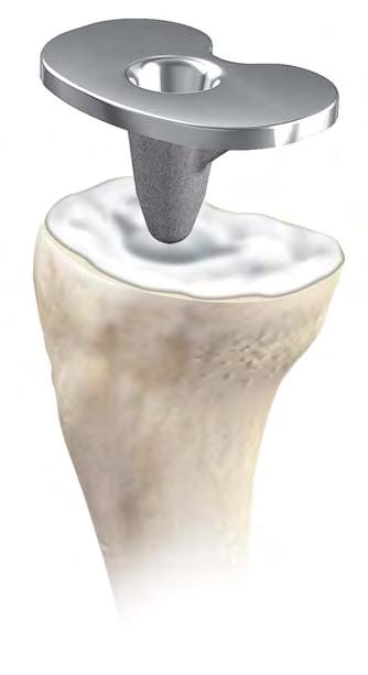 Any residual small cavity bone defects should be packed with cancellous autograft, allograft or synthetic bone substitutes such as Conduit TCP Granules.