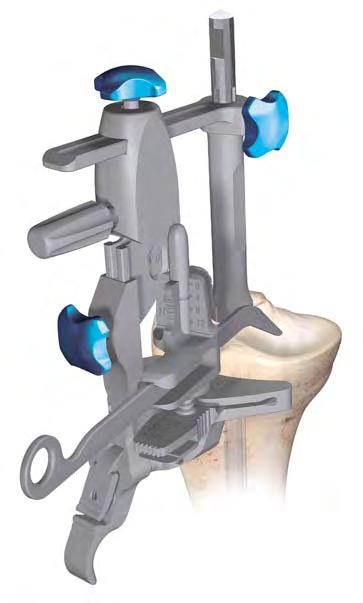 If the stylus is placed on the more damaged side of the tibia plateau, set the stylus to 0 mm or 2 mm (Figure 82).
