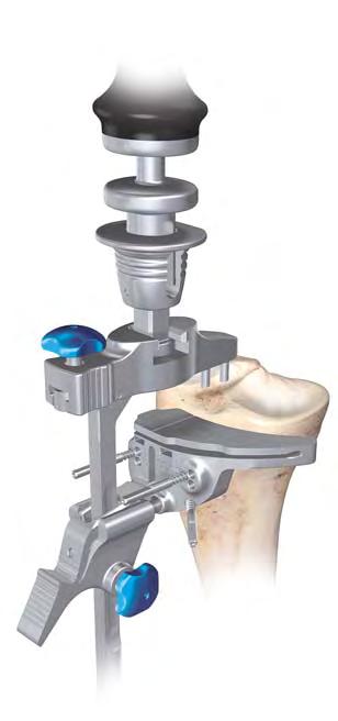the cutting block. If planning to resect through the slot, position the foot of the tibial stylus marked slotted into the slot of the tibial cutting block (Figure 88).