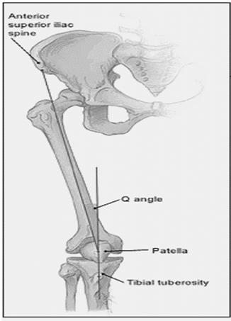 2. Increased Q angle Q Angle 2 lines ASIS to mid patella Mid patella to tibial