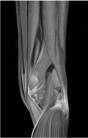 Anterior Knee Pain Patellofemoral Pain Syndrome Patellofemoral pain syndrome Fractures: femur, tibia, fibula, patella Muscle strains: quadriceps Tendinopathies: patellar, quadriceps, pes ancerinus