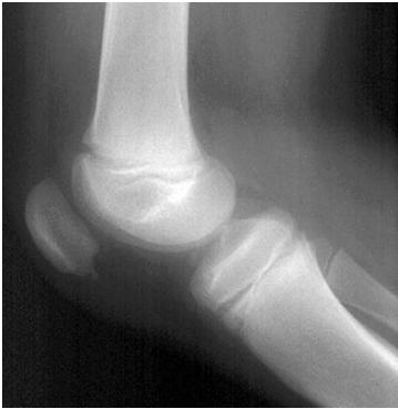 Sinding-Larson-Johannson Disease Osteoarthritis Boney fragmentation of the inferior pole of the patella in adolescence caused by a tendinitis of the proximal patellar tendon,