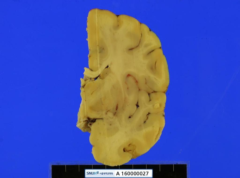 Kyuho Lee, et al. A B C D Fig. 1. (A-D) Grossly, there are no significant lesions on the exterior and cut surfaces of the brain. (C) Mamillary and lateral geniculate bodies look atrophic.
