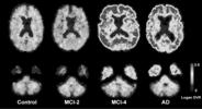 FDG PET Metabolic Signatures Disease Brain regions with reduced FDG uptake Alzheimer disease (AD) Dementia with Lewy bodies (LBD) Frontotemporal dementia (FTD) Parkinson disease (PD) Olivo-ponto