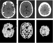 Fronto-temporal Dementia (FTD) Changes of personality and executive function, aphasia Apathy or disinhibited, bizarre behavior Fronto-temporal lobar atrophy Mostly sporadic