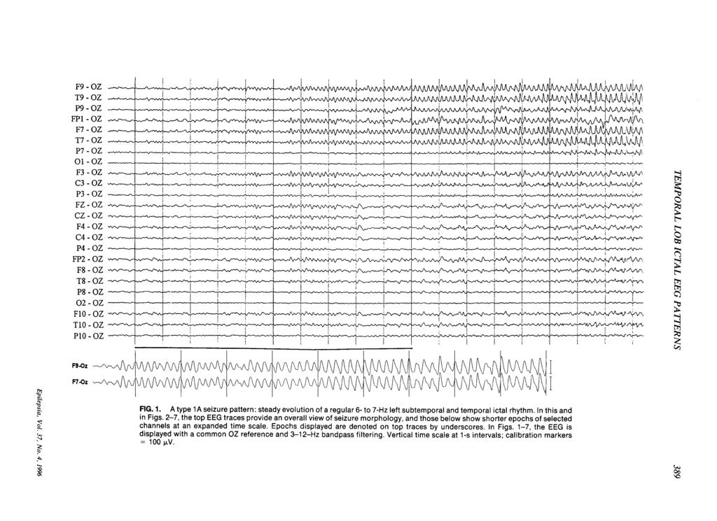 P4-OZ --- P8-oz --- F10 - OZ w- T10 - OZ -- u- --- I x FIG. 1. A type 1A seizure pattern: steady evolution of a regular 6- to 7-Hz left subtemporal and temporal ictal rhythm. In this and in Figs.