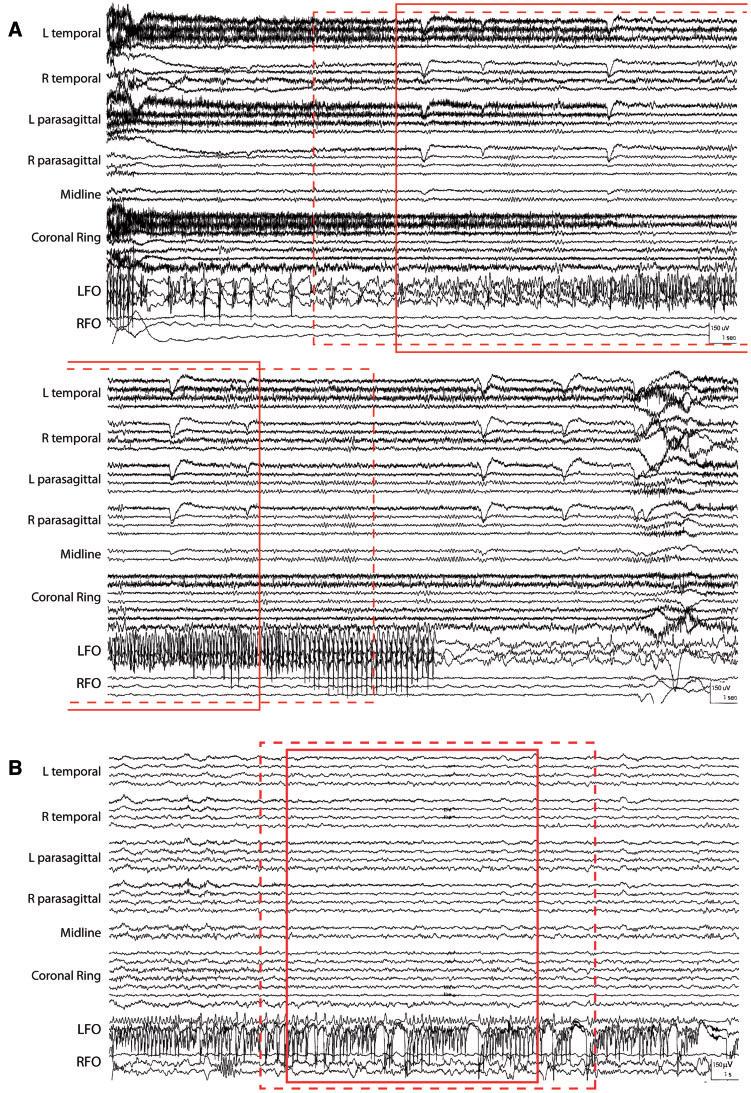 2688 BRAIN 2016: 139; 2679 2693 A. D. Lam et al. Figure 5 Examples of scalp-negative seizures that were successfully detected using the combined coherence and coherence PCA detectors.