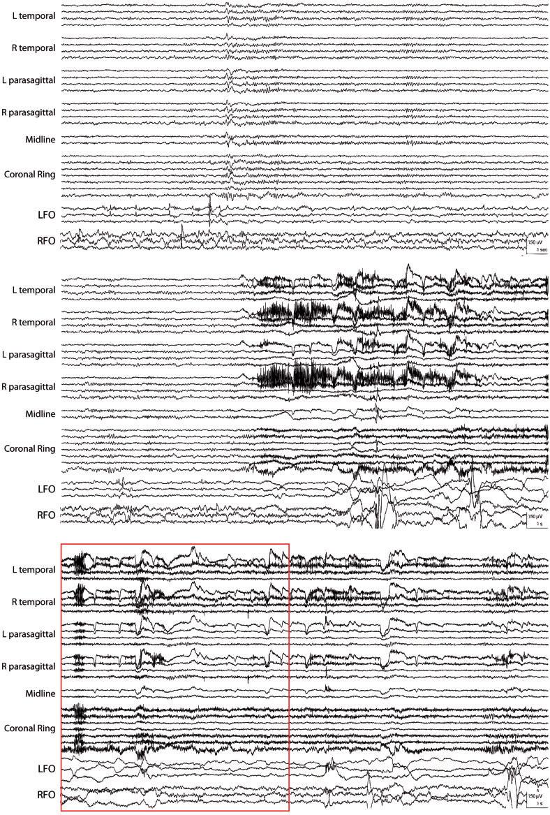 Non-invasive detection of deep seizures BRAIN 2016: 139; 2679 2693 2689 Figure 6 Example of a typical false alarm from the combined coherence and coherence PCA detectors.