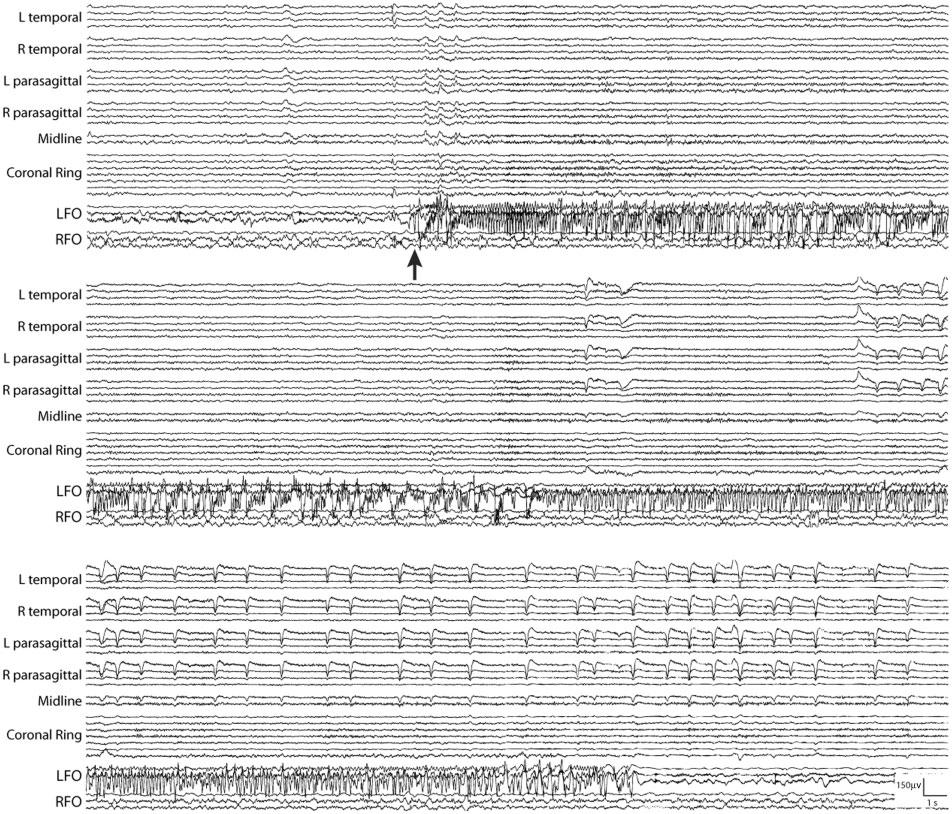 2682 BRAIN 2016: 139; 2679 2693 A. D. Lam et al. Figure 1 Representative EEG of a scalp-negative seizure.