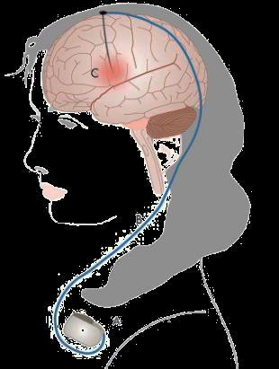 Deep brain stimulation (DBS) Direct electrical stimulation through electrodes implanted into the brain Modulation Change in firing