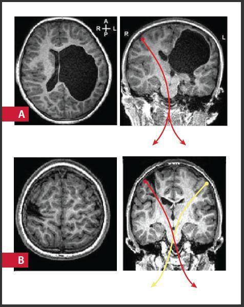 Corticospinal tract integrity in