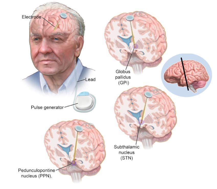 Deep Brain Stimulation (DBS) for Parkinson s Disease