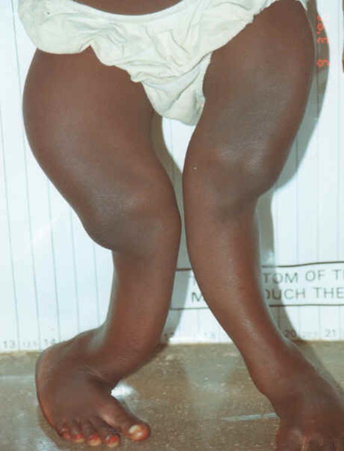 8. Rickets Rickets is the softening and weakening of bones in children, usually because of an extreme