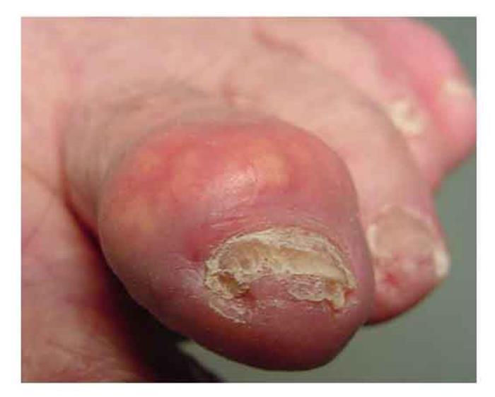 Chronic gout can also lead to deposits of hard lumps of uric acid